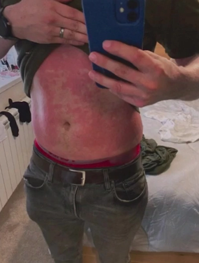 Andrew visare sin mage full av eksem